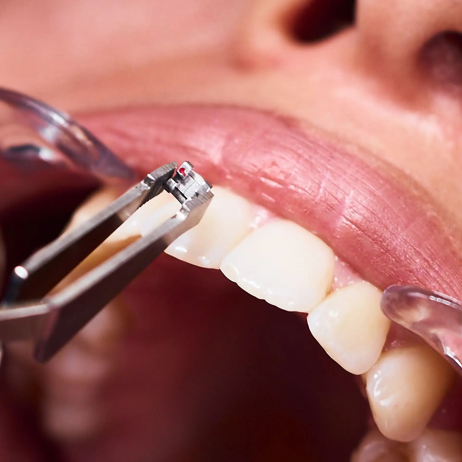 Consultation d'orthodontie parodontale au cabinet